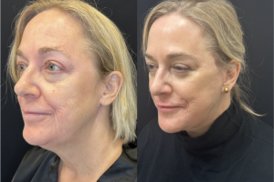 56-y.o-female-Deep-Plane-Facelift-Necklift-and-Lower-Blepharoplasty-1-2