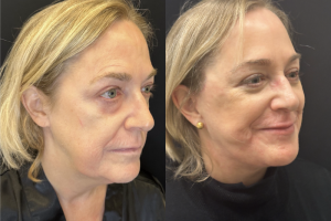 56-y.o-female-Deep-Plane-Facelift-Necklift-and-Lower-Blepharoplasty-1-3