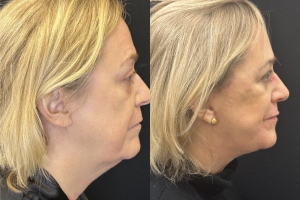 56-y.o-female-Deep-Plane-Facelift-Necklift-and-Lower-Blepharoplasty-1-4