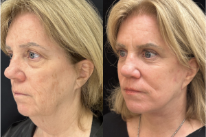 60-y.o-female-Deep-Plane-Facelift-Necklift-Upper-Lower-Blepharoplasty-and-Facial-Fat-Transfer-1-1
