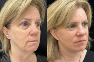 60-y.o-female-Deep-Plane-Facelift-Necklift-Upper-Lower-Blepharoplasty-and-Facial-Fat-Transfer-1-2
