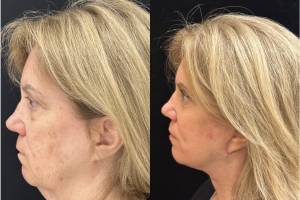60-y.o-female-Deep-Plane-Facelift-Necklift-Upper-Lower-Blepharoplasty-and-Facial-Fat-Transfer-1-4