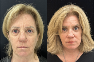 60-y.o-female-Deep-Plane-Facelift-Necklift-Upper-Lower-Blepharoplasty-and-Facial-Fat-Transfer-1-5