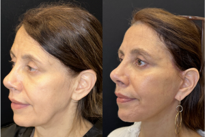 57-y.o-female-Awake-Deep-Plane-Facelift-Necklift-and-Facial-Fat-Transfer-1-1