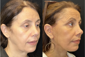 57-y.o-female-Awake-Deep-Plane-Facelift-Necklift-and-Facial-Fat-Transfer-1-2