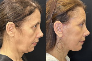 57-y.o-female-Awake-Deep-Plane-Facelift-Necklift-and-Facial-Fat-Transfer-1-3