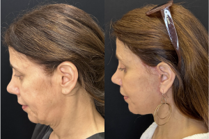 57-y.o-female-Awake-Deep-Plane-Facelift-Necklift-and-Facial-Fat-Transfer-1-4