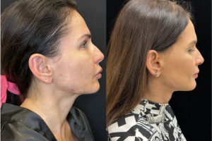 43-y.o-female-awake-Deep-Plane-Facelift-and-Necklift-1-1