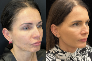 43-y.o-female-awake-Deep-Plane-Facelift-and-Necklift-1-2