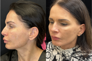 43-y.o-female-awake-Deep-Plane-Facelift-and-Necklift-1-3