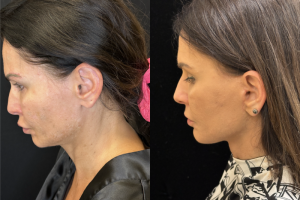 43-y.o-female-awake-Deep-Plane-Facelift-and-Necklift-1-4