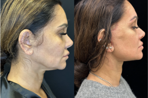 43-y.o-female-Deep-Plane-facelift-and-necklift-1-1