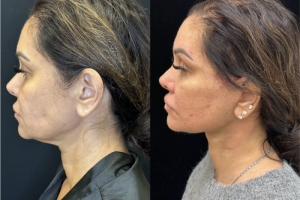 43-y.o-female-Deep-Plane-facelift-and-necklift-1-2