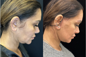 43-y.o-female-Deep-Plane-facelift-and-necklift-1-3