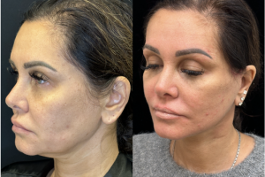 43-y.o-female-Deep-Plane-facelift-and-necklift-1-4