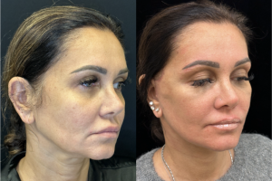 43-y.o-female-Deep-Plane-facelift-and-necklift-1-5