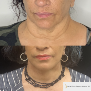 58-y.o-female-Awake-Deep-Plane-Facelift-Necklift-1-1