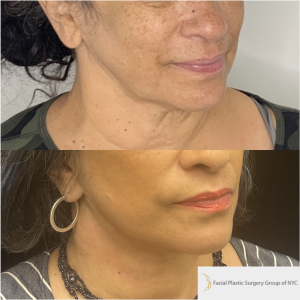 58-y.o-female-Awake-Deep-Plane-Facelift-Necklift-1-2
