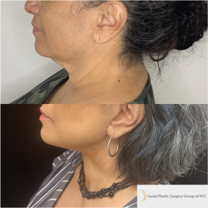 58-y.o-female-Awake-Deep-Plane-Facelift-Necklift-1-4