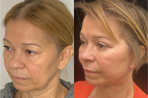 60-y.o-female-Deep-Plane-Facelift-Necklift-Upper-and-Lower-blepharoplasty-and-facial-fat-transfer-1-1