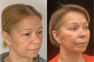 60-y.o-female-Deep-Plane-Facelift-Necklift-Upper-and-Lower-blepharoplasty-and-facial-fat-transfer-1-2
