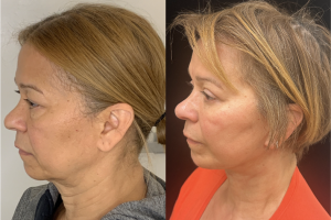 60-y.o-female-Deep-Plane-Facelift-Necklift-Upper-and-Lower-blepharoplasty-and-facial-fat-transfer-1-3