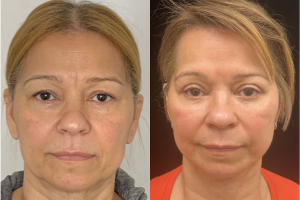 60-y.o-female-Deep-Plane-Facelift-Necklift-Upper-and-Lower-blepharoplasty-and-facial-fat-transfer-1-4