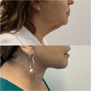 64-y.o-female-Awake-Deep-Plane-Facelift-and-Necklift-1-1