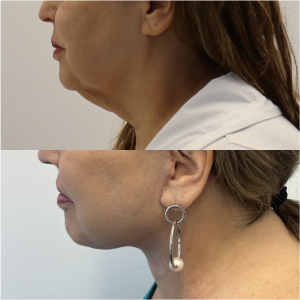 64-y.o-female-Awake-Deep-Plane-Facelift-and-Necklift-1-2