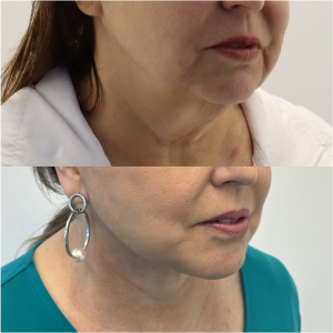 64-y.o-female-Awake-Deep-Plane-Facelift-and-Necklift-1-3