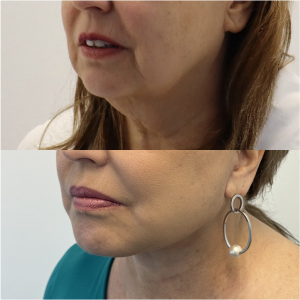 64-y.o-female-Awake-Deep-Plane-Facelift-and-Necklift-1-4