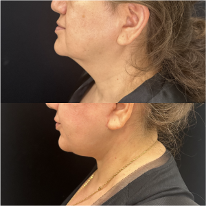 57-y.o-female-Awake-Deep-Plane-Facelift-and-Necklift-1-1