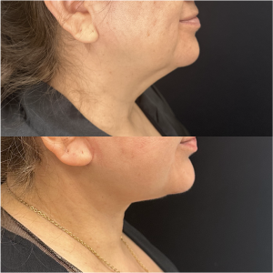 57-y.o-female-Awake-Deep-Plane-Facelift-and-Necklift-1-2