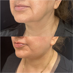 57-y.o-female-Awake-Deep-Plane-Facelift-and-Necklift-1-3