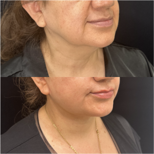 57-y.o-female-Awake-Deep-Plane-Facelift-and-Necklift-1-4