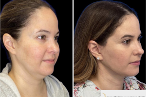 46-y.o-female-who-underwent-Deep-Plane-Facelift-Extended-Deep-plane-Neck-Lift-1