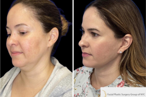46-y.o-female-who-underwent-Deep-Plane-Facelift-Extended-Deep-plane-Neck-Lift-2