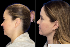 46-y.o-female-who-underwent-Deep-Plane-Facelift-Extended-Deep-plane-Neck-Lift-3