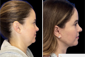46-y.o-female-who-underwent-Deep-Plane-Facelift-Extended-Deep-plane-Neck-Lift-4