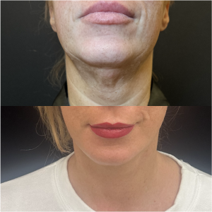 40-y.o-female-Awake-Deep-Plane-Facelift-and-Necklift-1-1