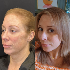 40-y.o-female-Awake-Deep-Plane-Facelift-and-Necklift-1-2