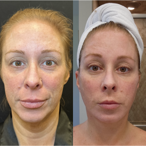 40-y.o-female-Awake-Deep-Plane-Facelift-and-Necklift-1-3