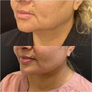 50-y.o-female-Awake-Deep-Plane-Facelift-and-Necklift-1-1
