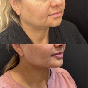 50-y.o-female-Awake-Deep-Plane-Facelift-and-Necklift-1-2