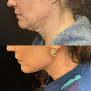 48-y.o-female-Awake-Deep-Plane-Facelift-and-Necklift-1-1
