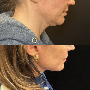 48-y.o-female-Awake-Deep-Plane-Facelift-and-Necklift-1-2