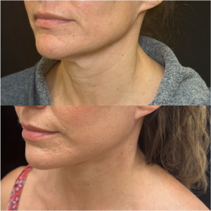 48-y.o-female-Awake-Deep-Plane-Facelift-and-Necklift-1-3