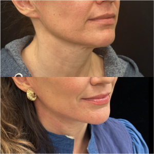 48-y.o-female-Awake-Deep-Plane-Facelift-and-Necklift-1-4
