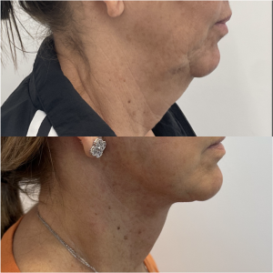 59-y.o-female-Awake-Deep-Plane-Facelift-and-Necklift-1-1