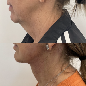 59-y.o-female-Awake-Deep-Plane-Facelift-and-Necklift-1-2